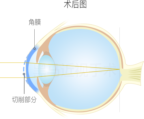 术后图
