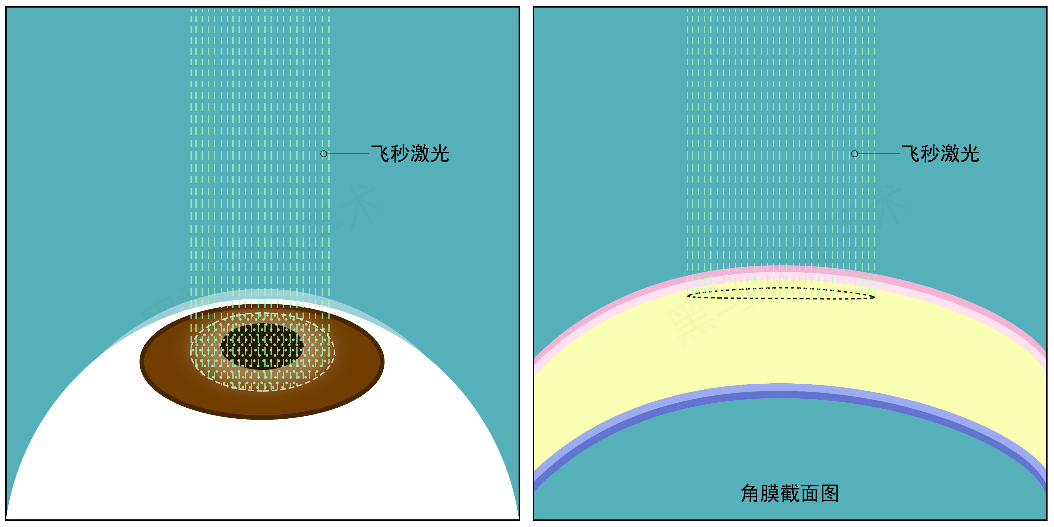 全飞秒步骤二 全飞秒步骤二
