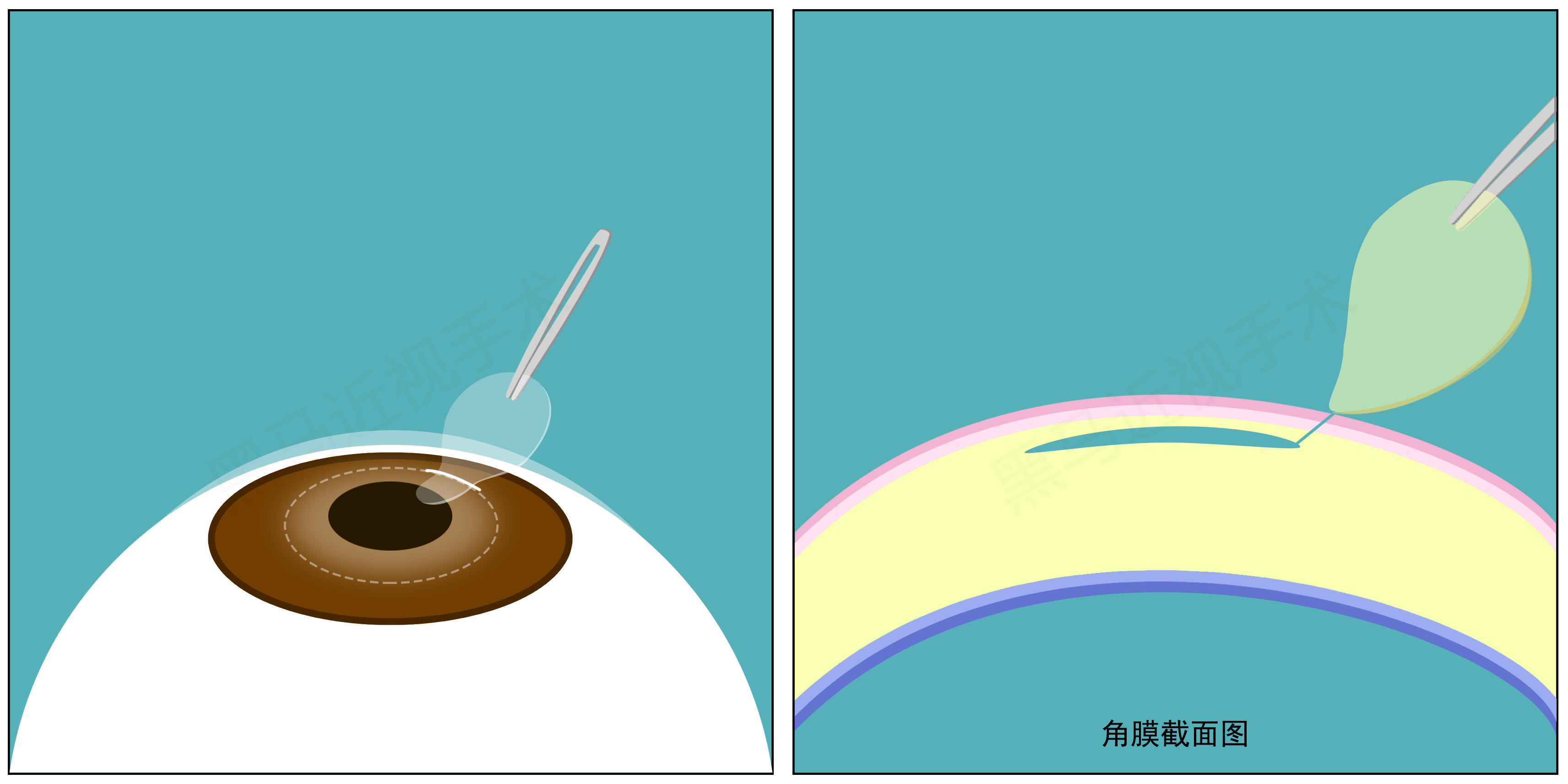 全飞秒步骤四 全飞秒步骤四